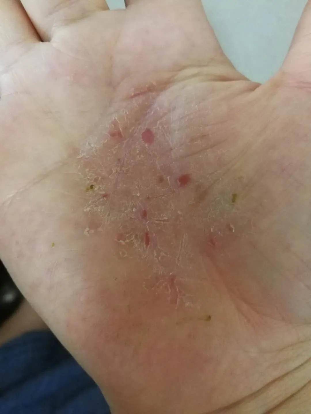 涂秋鸿医师 | 鸡蛋黄治哺乳期女性的湿疹_手机搜狐网