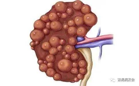 多發性腎囊腫是怎麼回事