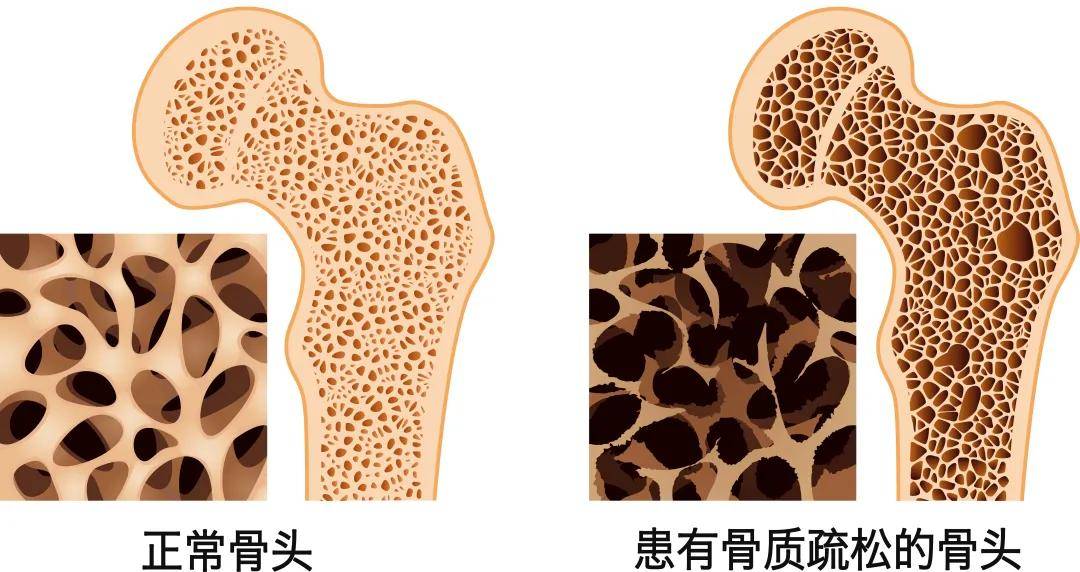 4个不良习惯,正在一步步毁掉你的骨头