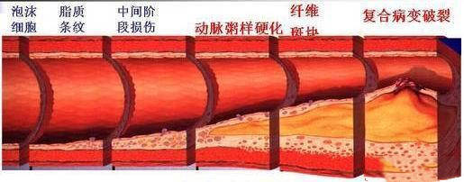 动脉粥样硬化纤维帽图片