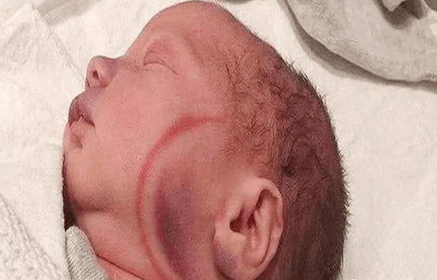 孕妇破水15小时,生产后娃意外死亡,家属:孩子是被产钳夹死的