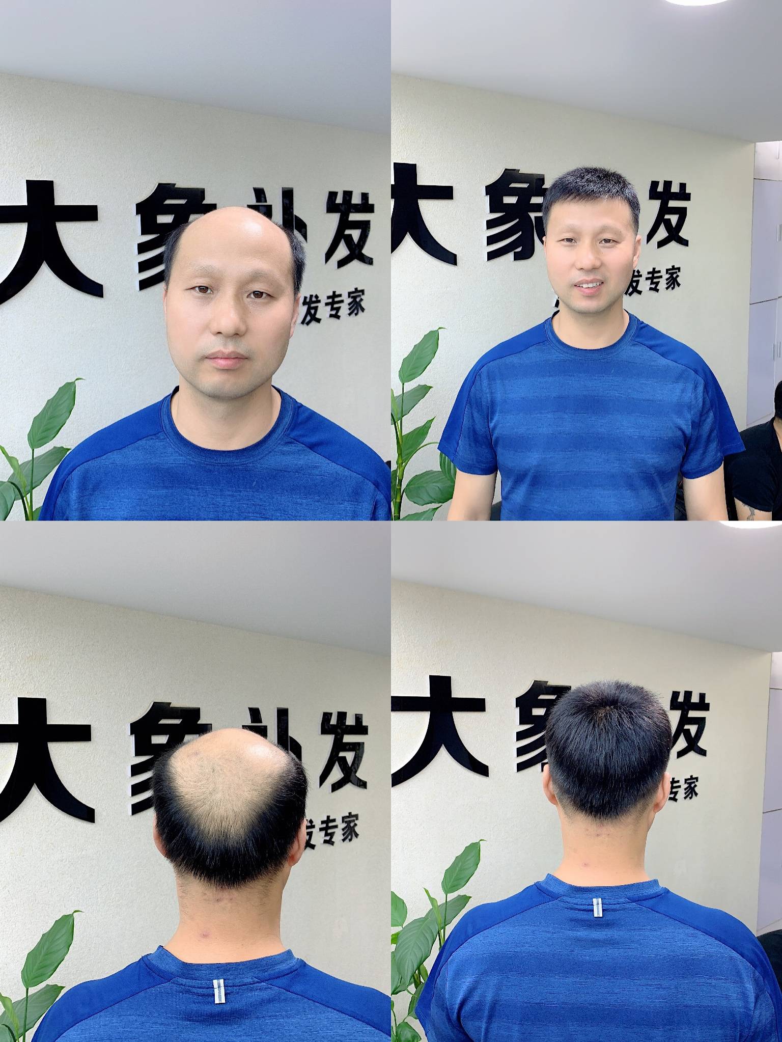 大象补发听说能让脱发者年轻十岁?