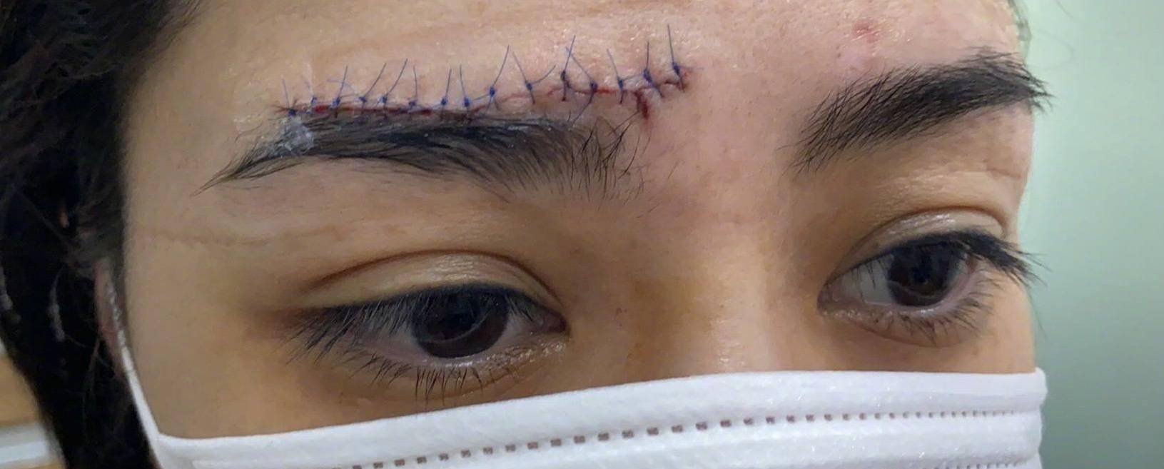 阿娇首晒伤口照!眉骨留下近5厘米蜈蚣疤,伤痕清晰可见