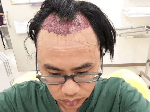 技能|别再问了！柏芮拉再生发逆龄术不是纹发，更不是植发！