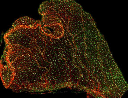 脉络丛产前炎症的导管