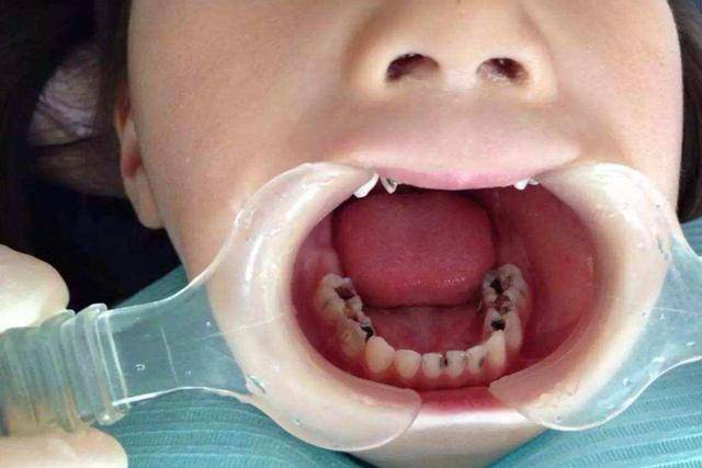 小孩不刷牙的后果图片图片
