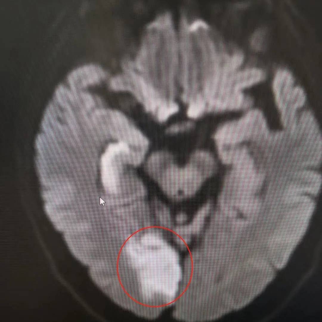 核磁共振检查显示枕叶梗死