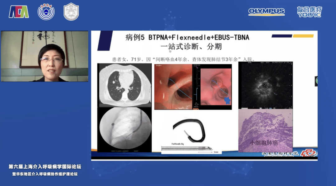 lungpro导航引导下行btpna术式和flexneedle进行ebus-tbna一站式诊断