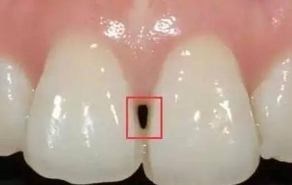 牙齿矫正之后后出现黑三角怎么办?