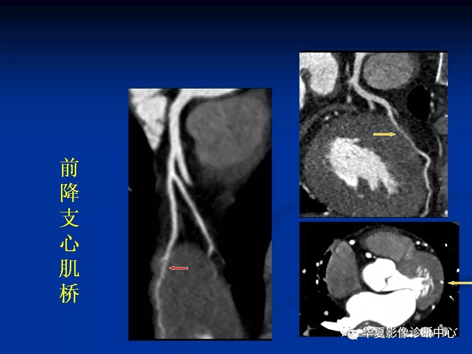 詳細解讀冠狀動脈及冠心病ct