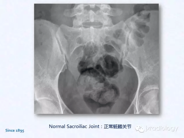 骶髂关节炎x线ct和mri表现