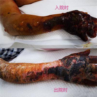 原创宁夏第四人民医院消化内科成功救治1例罕见重症皮肤炭疽