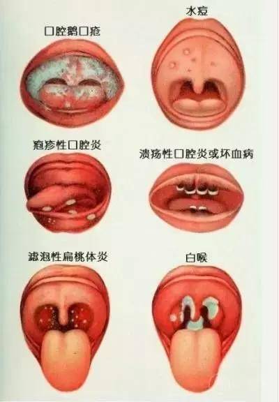 小儿鹅口疮图片图片