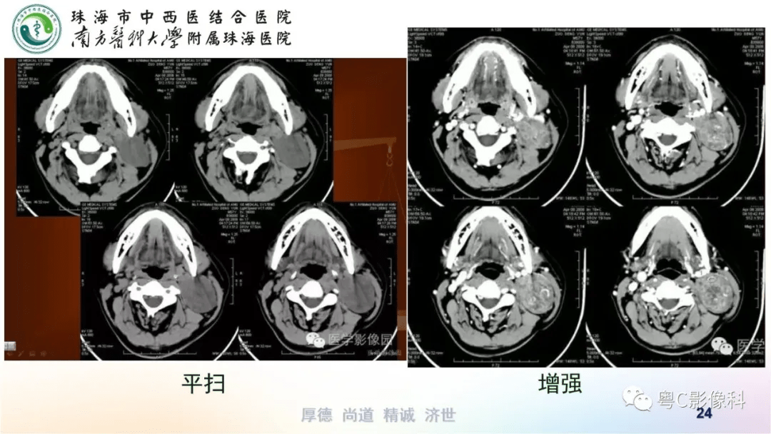 腮裂囊腫的ct表現知識總結