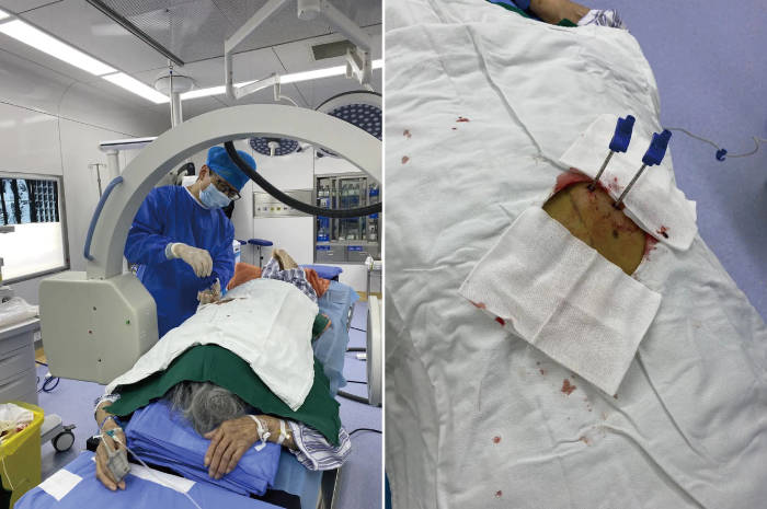 治疗|杭州城东医院案例丨90岁高龄椎体压缩性骨折新技术—?经皮穿刺椎体后凸成形术