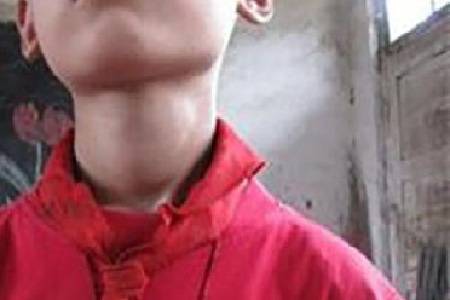 首大赵桂丽:哪些孩子更容易发生甲状腺癌