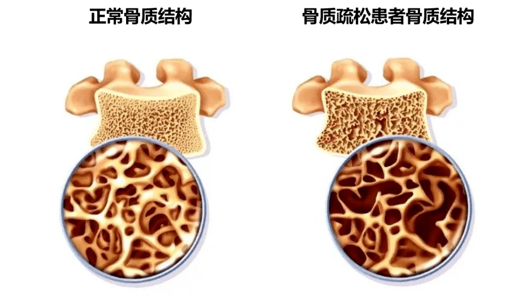 骨质疏松是怎么回事？吃什么药治疗效果好？_药物