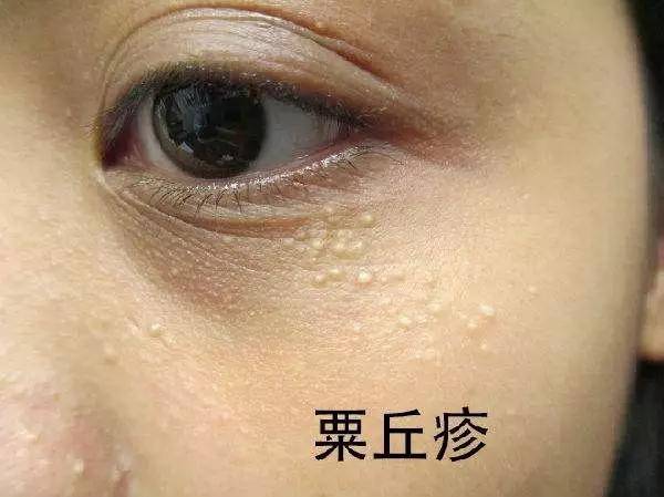 眼周脂肪粒咋去除