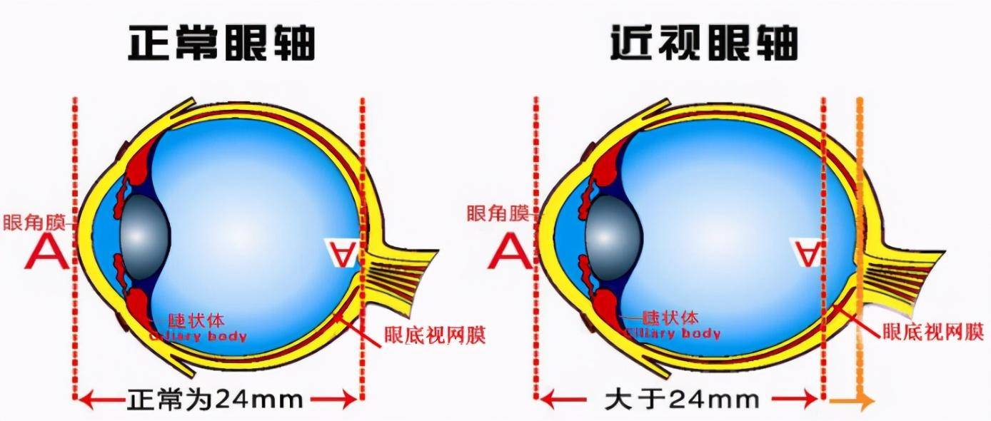 多少度算是高度近视?视网膜脱离怎么办?
