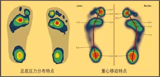 图2 高弓足压力特点后足跟骨外侧受力增加,第五跖骨头近端和远端受力