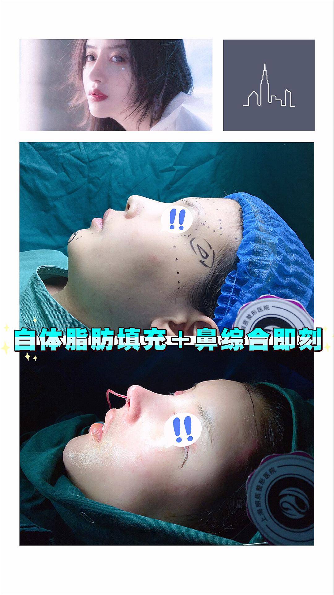 卢九宁院长聊假体丰眉弓术_手机搜狐网