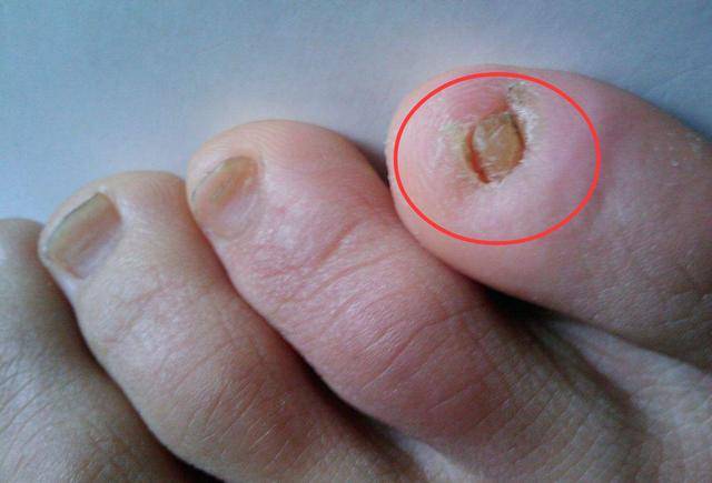 小脚趾的指甲分成两瓣的人,到底是古人的象征,还是病态的标记