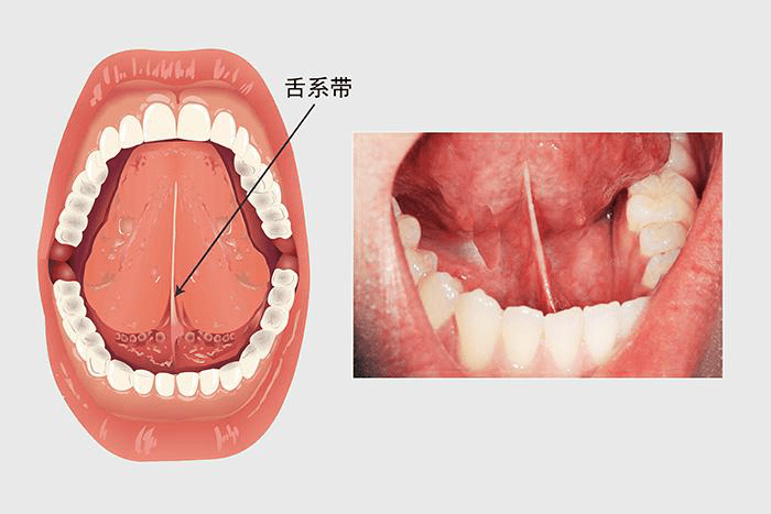 新生儿舌头连着筋的图图片