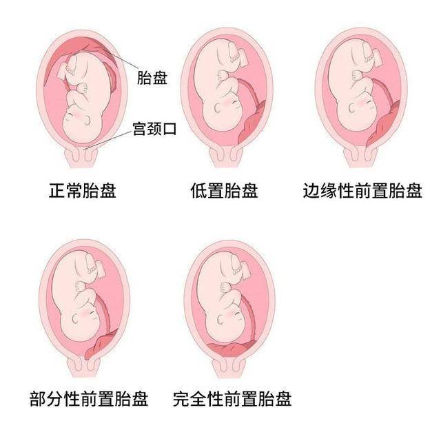 胎盘覆盖宫颈口图片图片