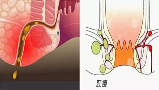 瘻管比較通暢沒有炎症的時候,一般不疼痛,只有肛門局部略有腫脹感