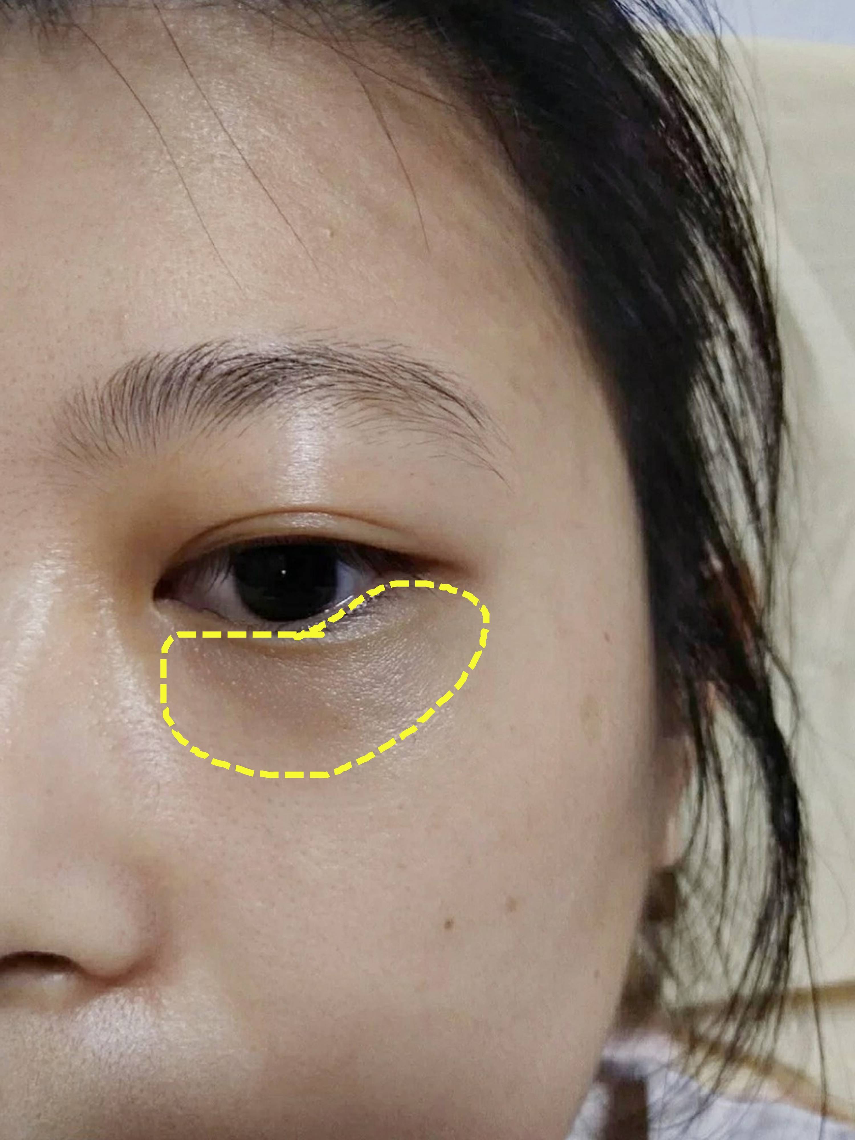 原相机记录多年的黑眼圈终于消失了