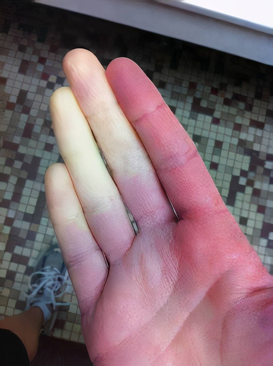 原创女孩手凉可能是病医生无法根治但可以注意这几点