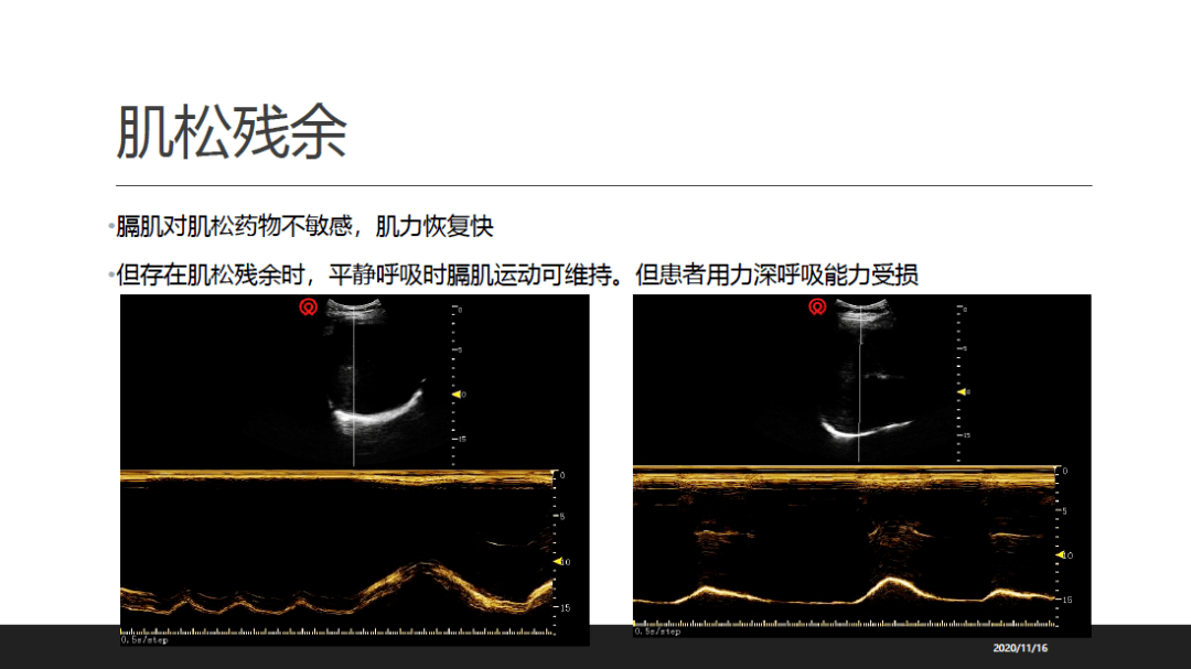 膈肌超声的应用