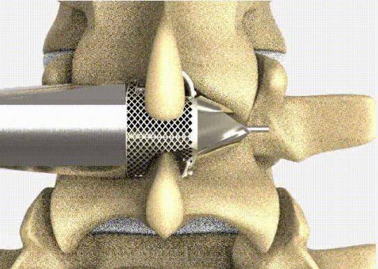 增材金属3d打印机开始用于脊柱植入物生产