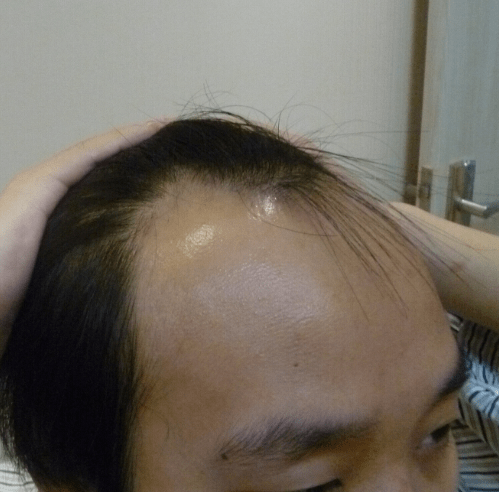 25岁男子发际线严重后移前后花了2万多反而越来越秃了