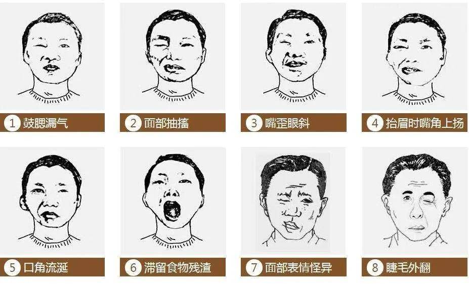 科普∣中西合璧治疗面瘫越早越好!(二)