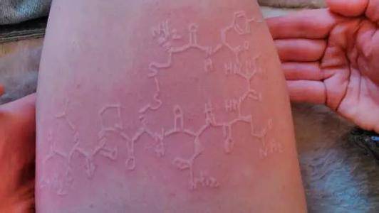 能性荨麻疹,热源性荨麻疹,日光性荨麻疹,运动性荨麻疹,水源性荨麻疹