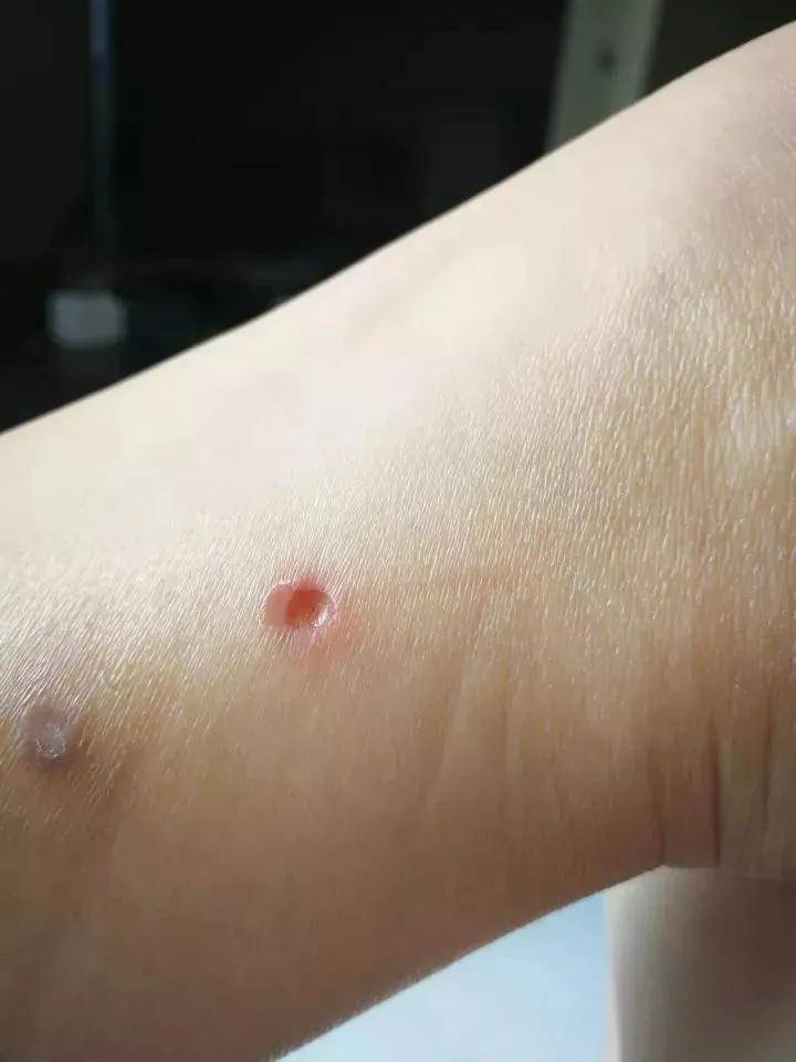 ""这要是破皮了会不会感染?""有没有修复灸疮的方法?