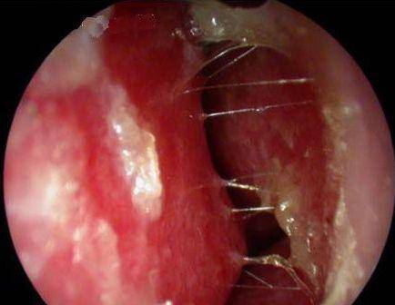 贵阳铭仁耳鼻喉医院科普你还在抠鼻子当心抠出鼻前庭炎严重的会危及