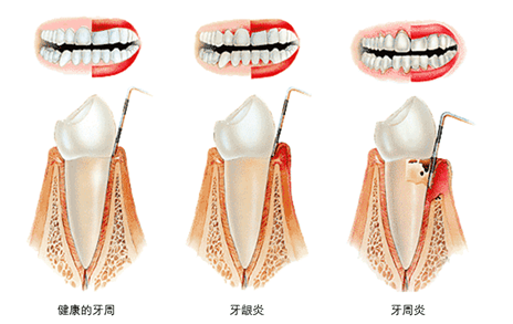 為什麼談起洗牙,人們的態度總是拒絕?_牙周