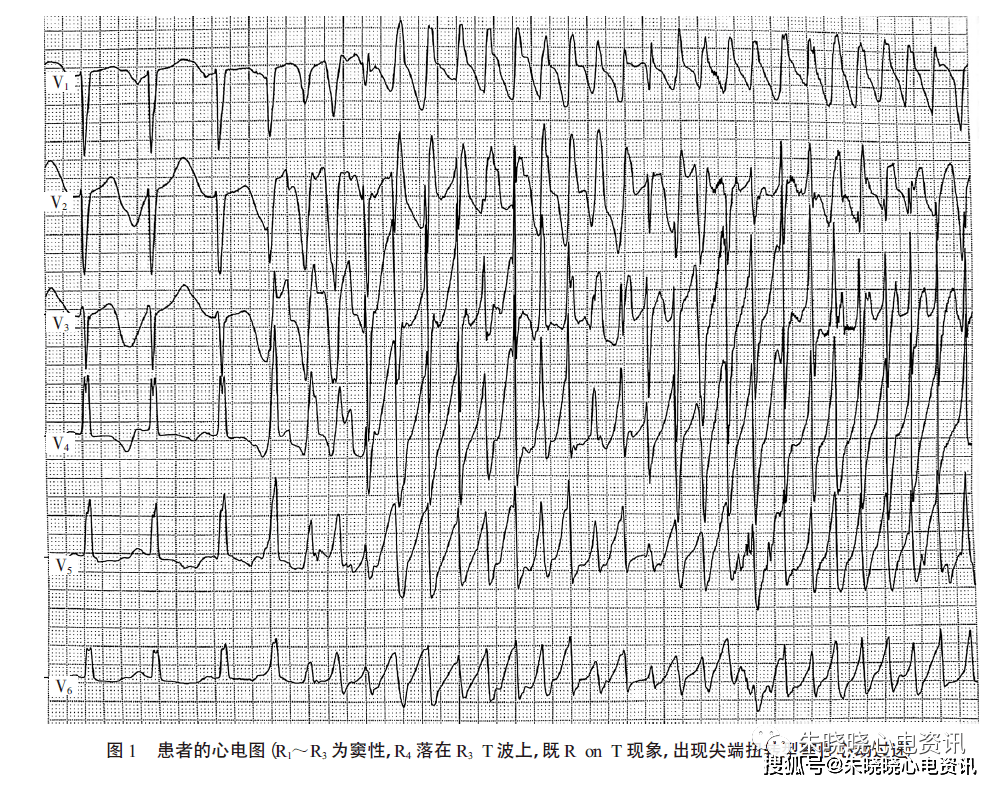 0mv),qt间期584ms;室性心律时,qrs形态多变且围绕等电位线连续扭转