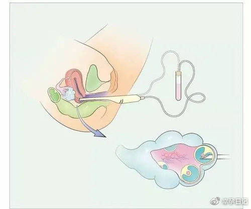试管婴儿蒙古试管婴儿试管婴儿如何进行取卵操作过程分为5个步骤