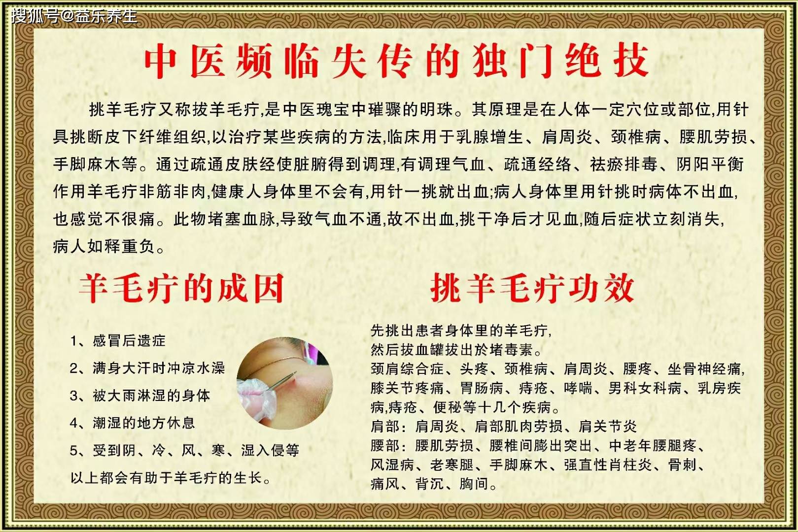 濒临失传的民间绝技挑羊毛疔