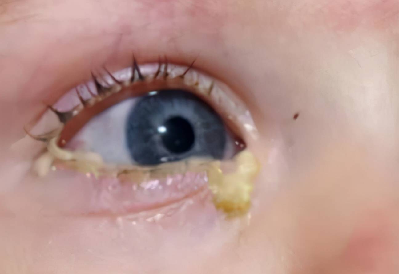 儿童眼睛红有眼屎图片图片