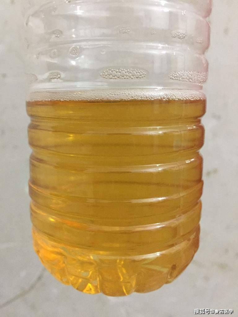 通过尿液看健康注意了这4种小便或许是身体在向你求救