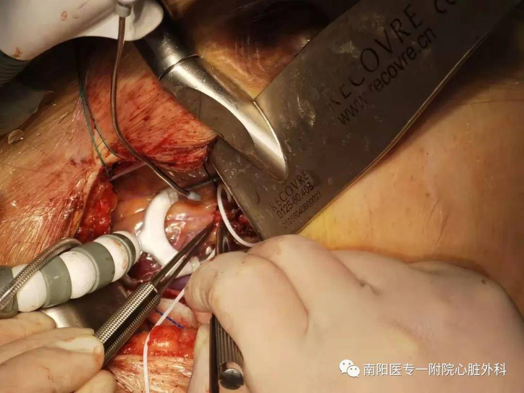 小切口—南阳医专一附院心脏外科成功开展微创冠状动脉搭桥手术