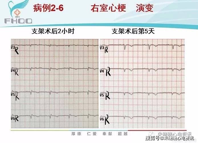 心肌缺血的心电图表现_后壁