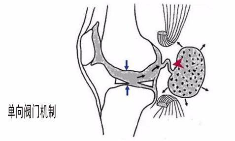 膕窩囊腫的形成機制:研究認為膝關節腔因為骨關節炎,半月板損傷等疾病