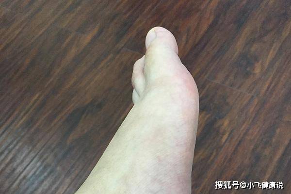 原创肝好不好,低头看看脚掌!脚掌发出的信号,别忽视