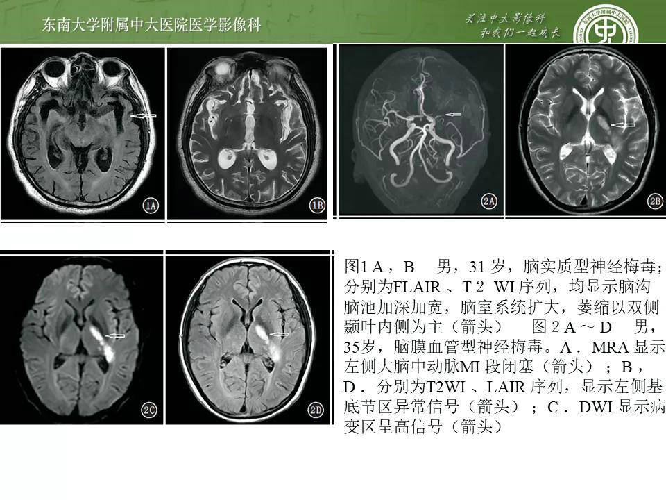 伟大的伪装者——神经梅毒【影像分析及鉴别诊断】