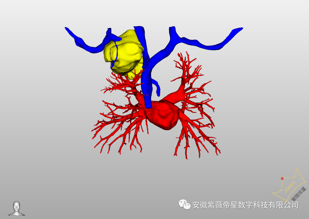 图丨病变与动脉血管关系图丨病变与血管关系图丨三维可视化前位三维